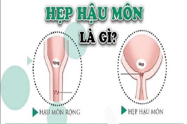 Hẹp hậu môn ở trẻ em: Nguyên nhân, biểu hiện, cách điều trị và phòng bệnh